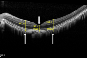 The pilot study of curing macular edema and retinopathy in diabetic primate model were accomplished on May, 2019
