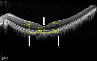 The pilot study of curing macular edema and retinopathy in diabetic primate model were accomplished on May, 2019
